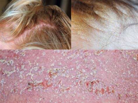 How I Cured Seborrheic Dermatitis Ar