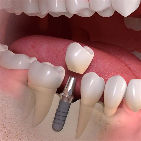 Single And Multiple Teeth Implants Sydney Ryde