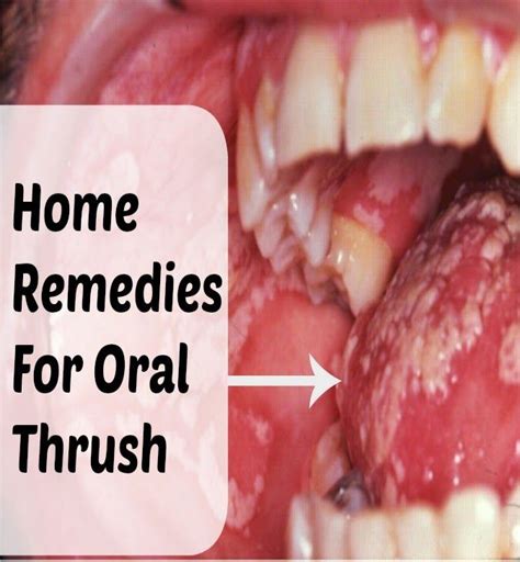 173 Best Images About Health Dry Mouth On Pinterest Sore Throat