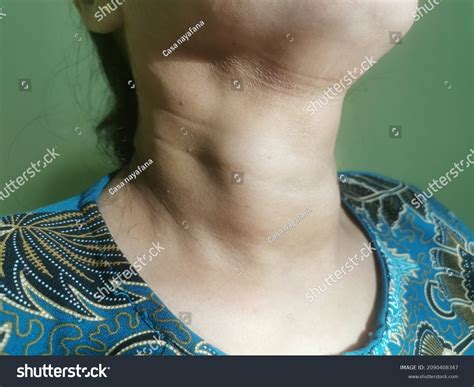 Huge Multinodular Goitre Asian Lady Stock Photo 2090408347 Shutterstock