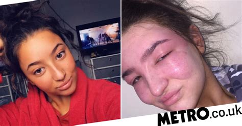 Womans At Home Eyebrow Tinting Reaction Makes Her Head Double In Size