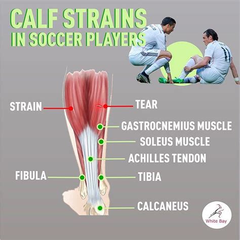 Calf Injuries In Adult Soccer Players Weston Florida