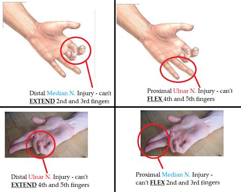 Image Result For Klumpkes Palsy Claw Hand Ulnar Nerve Peripheral