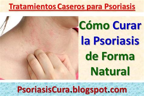 Psoriasis Cura ᐉ Cómo Curar La Psoriasis Con Remedios Caseros Ayurveda