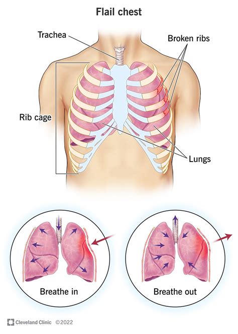 Bruised Rib Symptoms And Causes