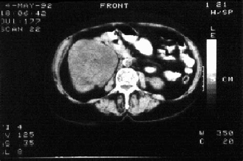 Case 1 Ct Scan Renal Cancer Of The Right Kidney Download