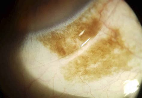 Brown Spot On The Eye Is It Serious Área Oftalmológica Avanzada