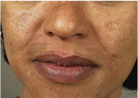 Melasma Centrofacial Variant With Sparing Of The Philt Open I