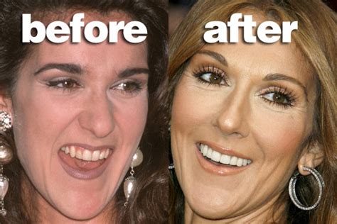 Fotos del antes y después de celebridades que pasaron por el dentista BLOGERIN