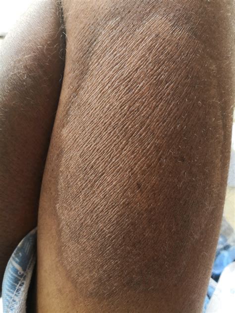 Mimin 29 Eczema Mild Psoriasis On Black Skin