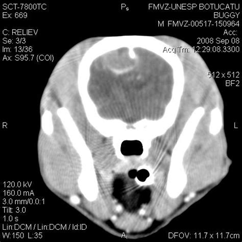 Corte Tomográfico Transversal Do Crânio Após Aplicação De Contraste