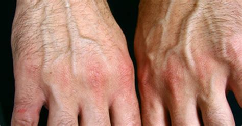 What Causes Arthritis Flare Ups Livestrongcom