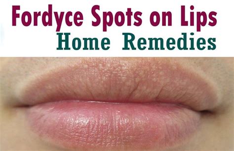 Fordyce Spots On Lips Treatment Apple Cider Vinegar And Honey