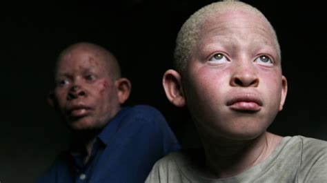 Albinism Africa Needs To Do More By Olusola Owonikoko Medium