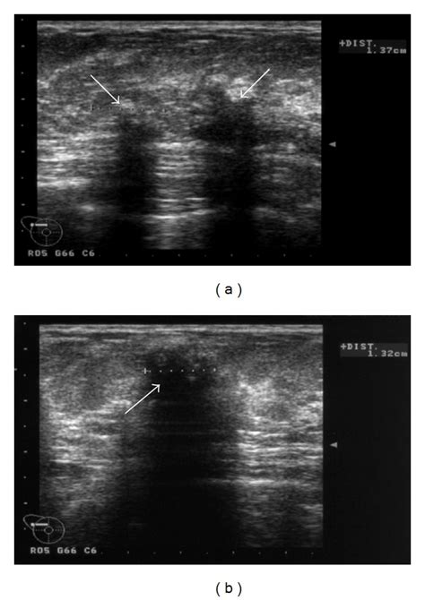 Ultrasound Shows Multiple Ill Defined Hypoechoic Areas With Acoustic