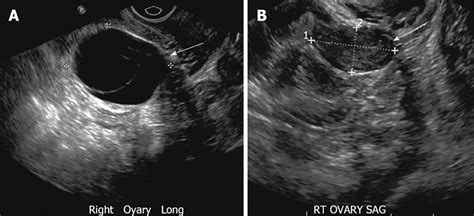 Ovarian Cyst And Cancer Ultrasound