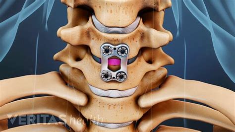 A Visual Guide To Anterior Cervical Discectomy And Fusion Acdf Surgery