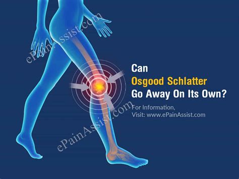 Can Osgood Schlatter Go Away On Its Own And What Are Its