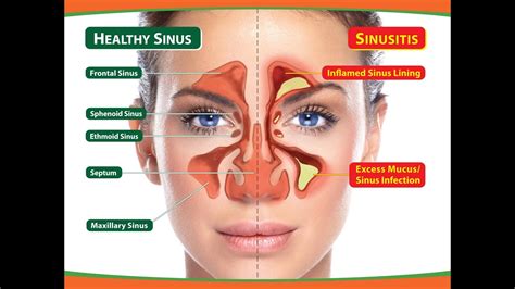 How To Cure Sinusitis Sinusitis Cured Instantly With New Invention