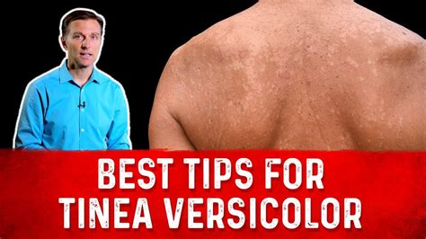 Does Tinea Versicolor Discoloration Go Away 13 Most Correct Answers
