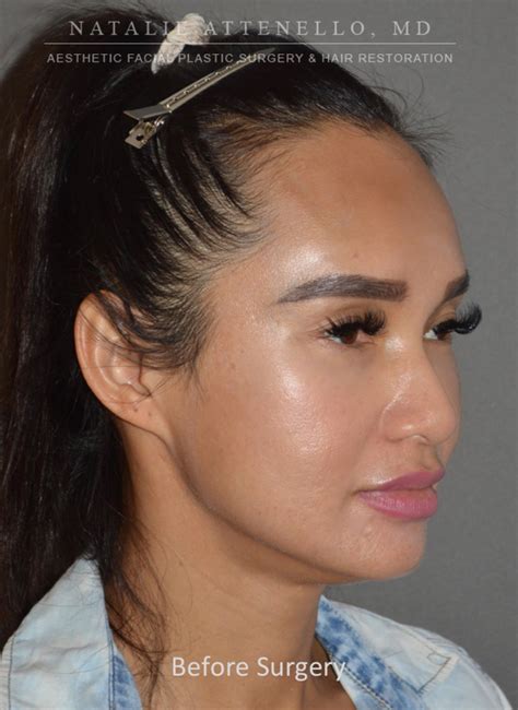 Beverly Hills Hairline Lowering Forehead Reduction Before And After