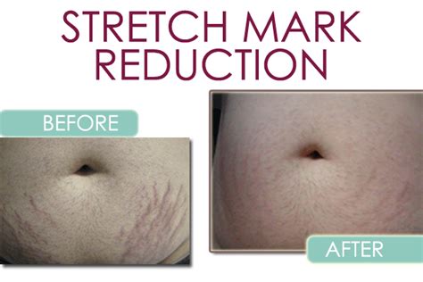 Stretch Mark Reduction National Laser Institute Medical Spa