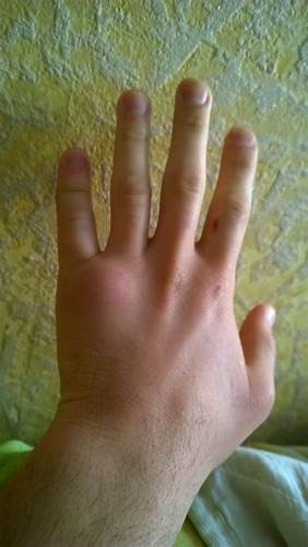 Может ли похудеть кисть руки