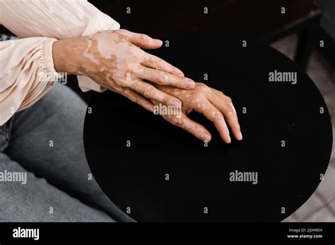 Hands With Vitiligo Skin Pigmentation On Black Background Close Up
