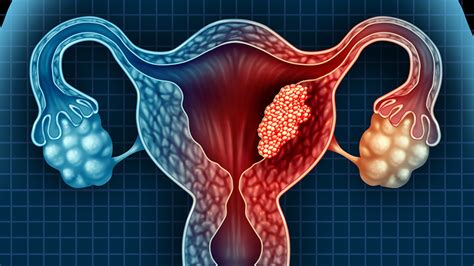 Endometrial cancer, sometimes called uterine cancer, starts in the uterus (female pelvic organ where fetal development takes place). Uterine Cancer Warning Signs to Watch For