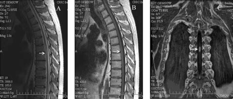 The Second Mri Images Of The Thoracic Spine A Sagittal T2 Weighted