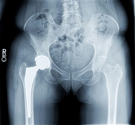 Surgeon Anterior Hip Replacement Is Viable Option For A Broad Range Of