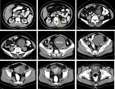 Ovarian Serous Cystadenocarcinoma Radiology Cases