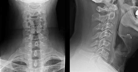 Cervical Spine Radiographs In The Trauma Patient