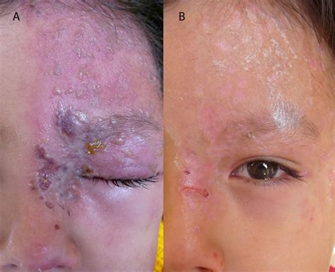 Herpes Zoster Ophthalmicus In A Healthy Child Bmj Case Reports