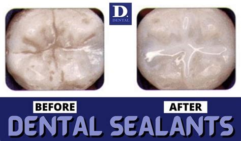 How Do Dental Sealants Prevent Cavities D Dental