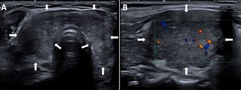 Enlarged Thyroid Ultrasound Image