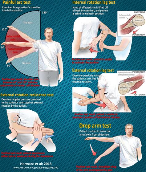 Rotator Cuff Shoulder Pain Diagnosis Chart