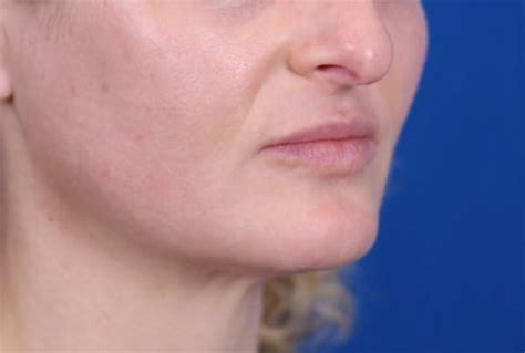 Patient 24802628 Permalip Lip Implants Before And After Photos