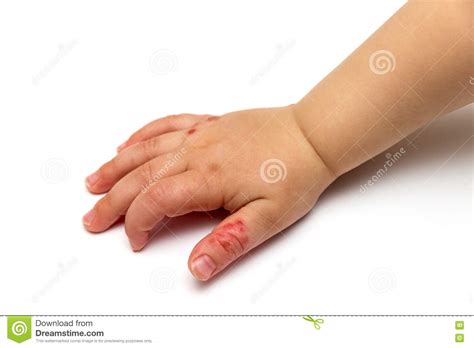 Ekzeme sind entzündungen der haut. Hand Eines Kindes Mit Atopic Ekzem Stockbild - Bild von ...