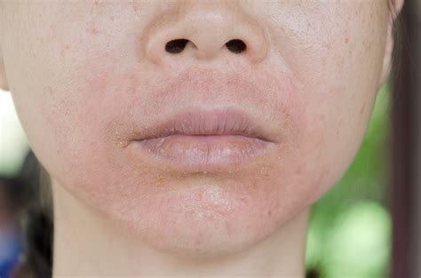 Symptoms Causes And Treatments Of Perioral Dermatitis Facty Health