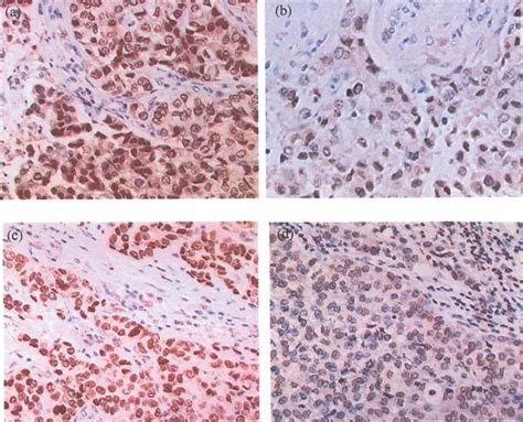 Immunohistochemical Staining Of Sections Of Primary Breast Carcinoma