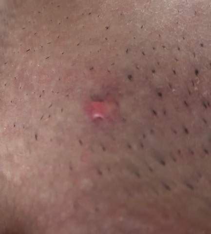 Pimple popper) 12.245.358 views2 year ago. Pickel zwischen Hoden und Oberschenkel. Bedeutung ...