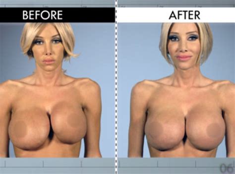 Transgender Breast Implants Before And After Play Pornstar Cleavage Min Xxx Video
