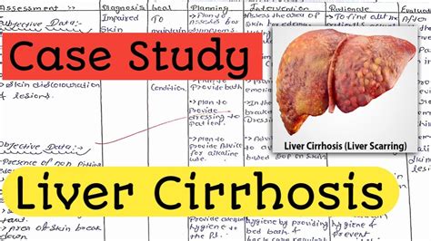 Case Study On Liver Cirrhosis Case Presentation Nursing Care Plan