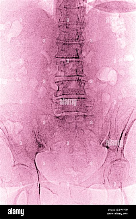 Vertebral Osteoarthritis X Ray Stock Photo Alamy