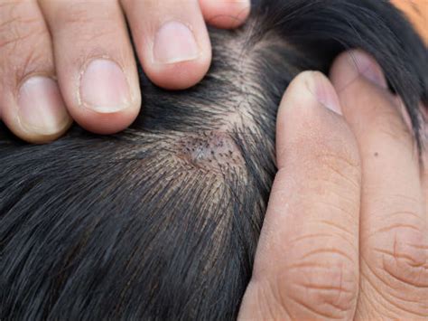 Boils On Scalp Causes Symptoms And Treatment