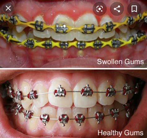 I Have Braces And Have Very Inflamed Gums Whats The Fastest Way To
