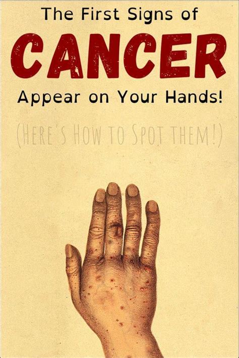 The First Signs Of Cancer Appear On Your Hands Heres How To Spot Them