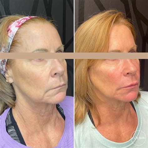 These Results Are After Our Signature Full Face Pdo Thread Lift And