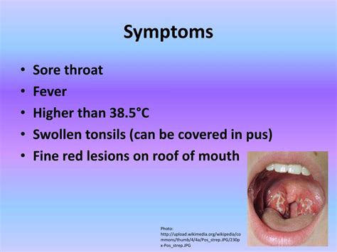 Ppt Streptococcal Pharyngitis Strep Throat Powerpoint Presentation